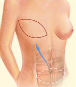 Breast Rectonstruction TRAM Flap