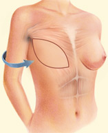 Provides the support for a breast implant