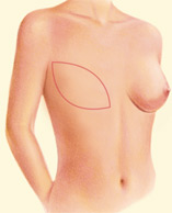Provides the support for a breast implant