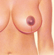 Breast Reduction - Vertical Incision, After