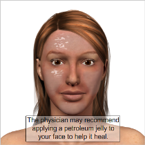 chemical peel