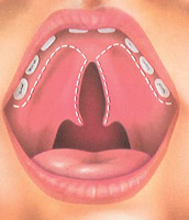 Cleft Palate Surgery - The Incision