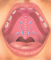 Cleft Lip and Palate - Closing the Incisions