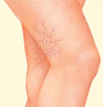 Leg Veins, Before