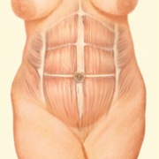 Tummy Tuck, Pre-Interior Incision