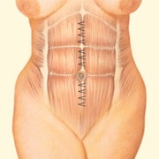 Tummy Tuck, Interior Incision