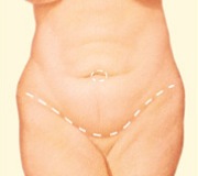 Tummy Tuck, Outline