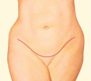 Tummy Tuck, Exterior Incision