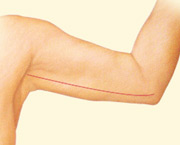 arm lift