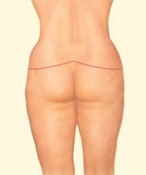 body lift body lift
