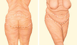 Body Lift Procedure Steps  American Society of Plastic Surgeons