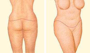 What is A Body Lift, Our Surgical Team