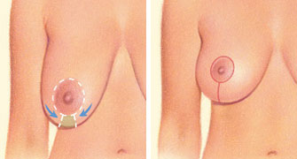 Breast lift incision vertical