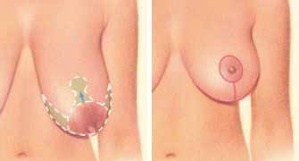 Breast lift incision horizontal