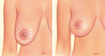 Breast lift incision around areola