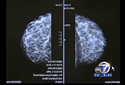 Nipple-Sparing Mastectomy Video