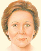 brow lift