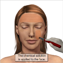 How Deep Chemical Peel Works