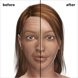 dermal fillers results