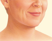 Necklift after