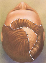 hair replacement hair replacement