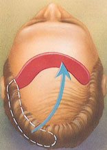hair replacement hair replacement