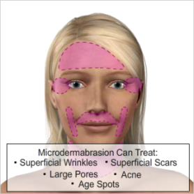 microdermabrasion