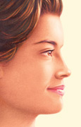 Nose Surgery, After Nose Surgery, After
