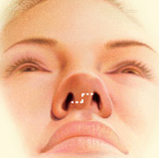 Nose surgery 