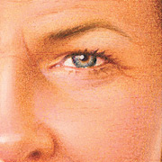 Laser Resurfacing, Before