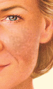 Laser Treatment, Before