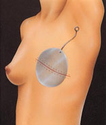 Breast expander