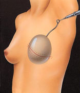breast expander