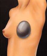 Breast expander