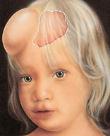 tissue expansion