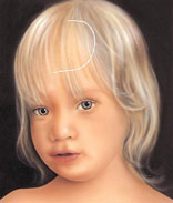 scalp expansion