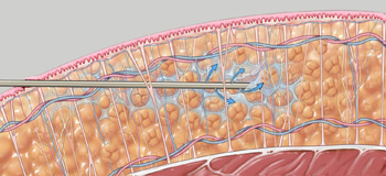 Vaser lipo