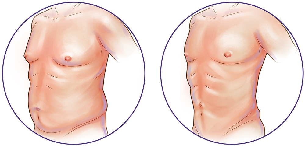 Liposuction chest and abdomen
