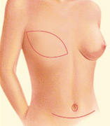 Breast Rectonstruction TRAM Flap