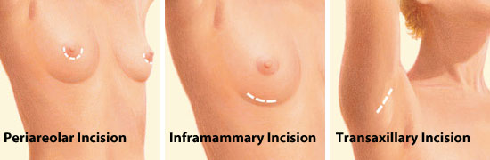 Breast augmentation incision is irritated