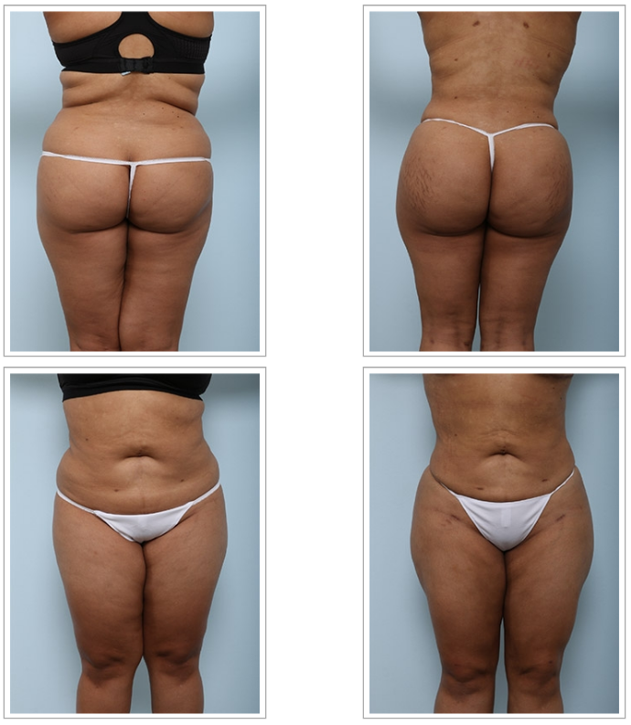 4 Ways a Brazilian Butt Lift Can Contour Your Body - Dr. Vitenas