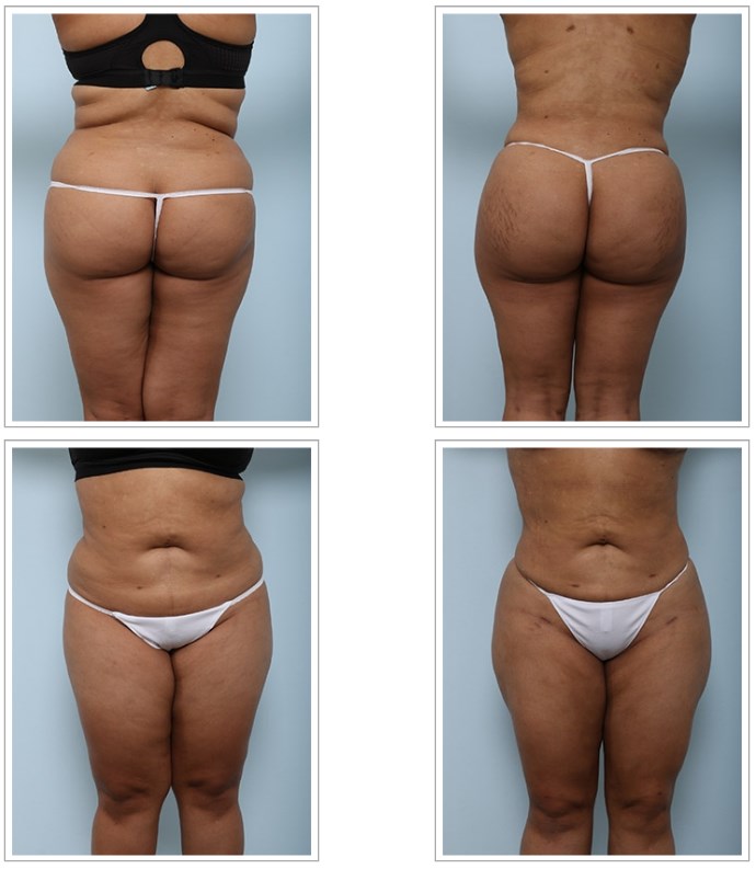 Are Butt Implants the Best Option For a Butt Augmentation?