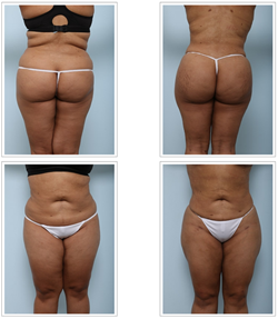 Four key things to know before your buttock augmentation consultation