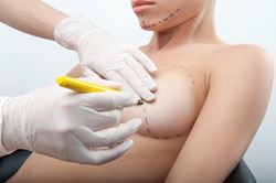 Misconceptions about breast augmentation and lift