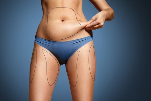 The skinny on CoolSculpting  American Society of Plastic Surgeons