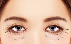 Is eyelid surgery right for you?