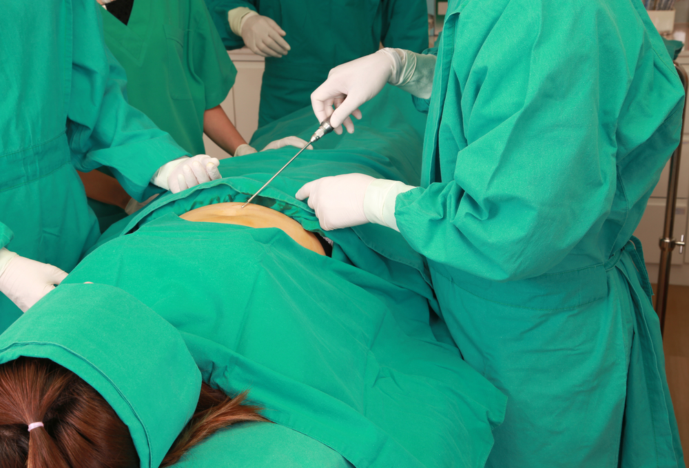 10 Things to Know About Tummy Tuck Surgery