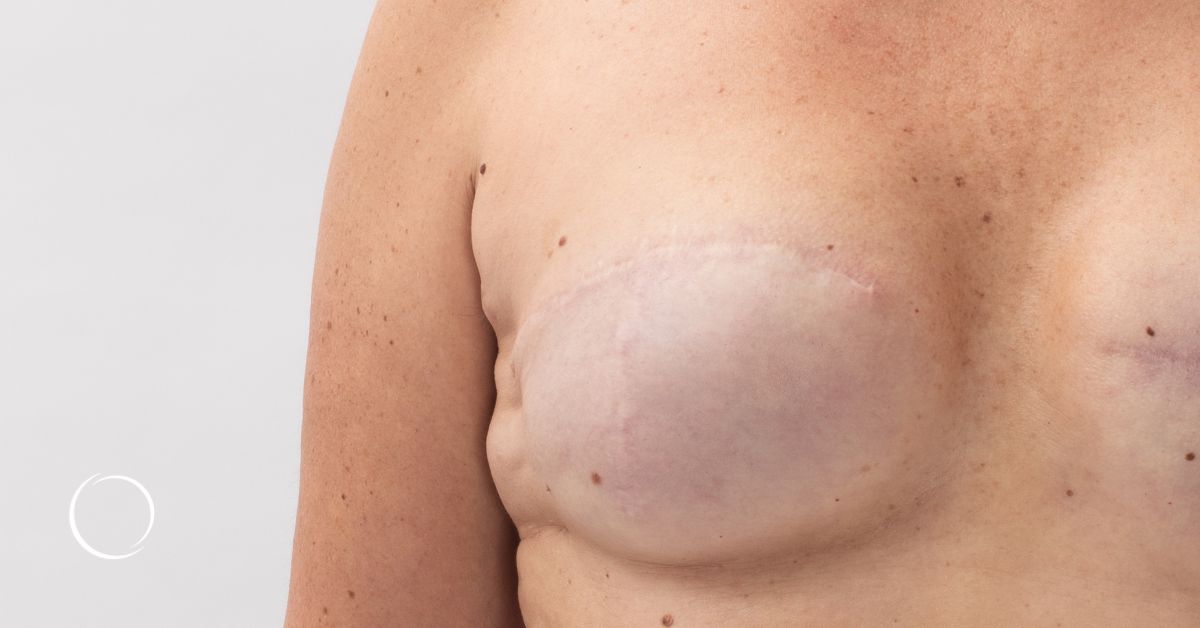 Pioneering progress: An in-depth exploration of DIEP flap breast