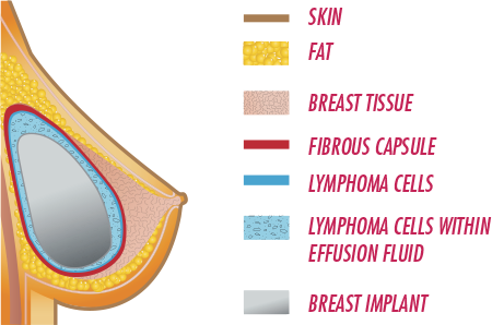 Breast Implant-Associated Anaplastic Large Cell Lymphoma (BIA-ALCL)