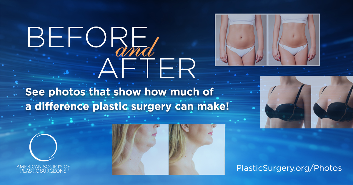 Liposuction Before and After Photos | American Society of Plastic ...